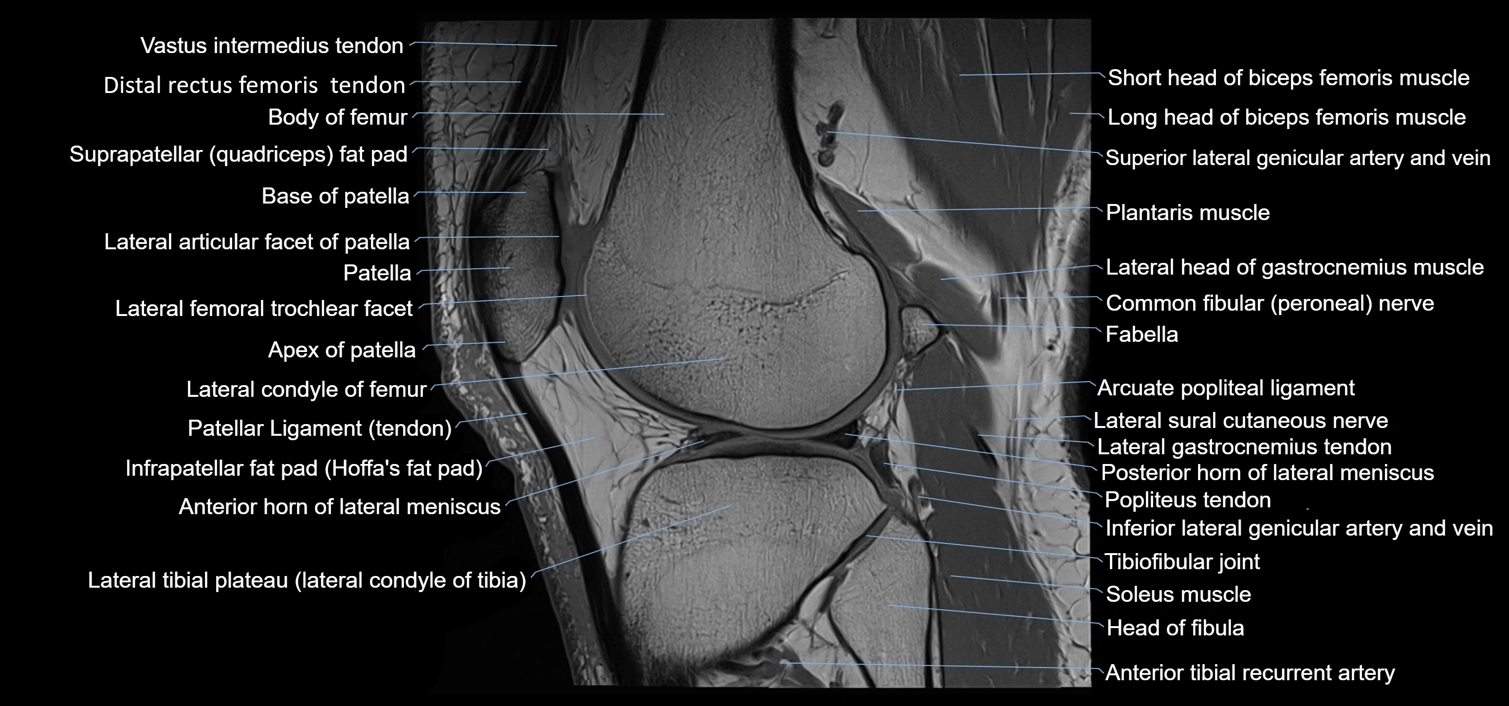 MRI knee sagittal cross sectional anatomy labelled 3T radiology image-00034.webp